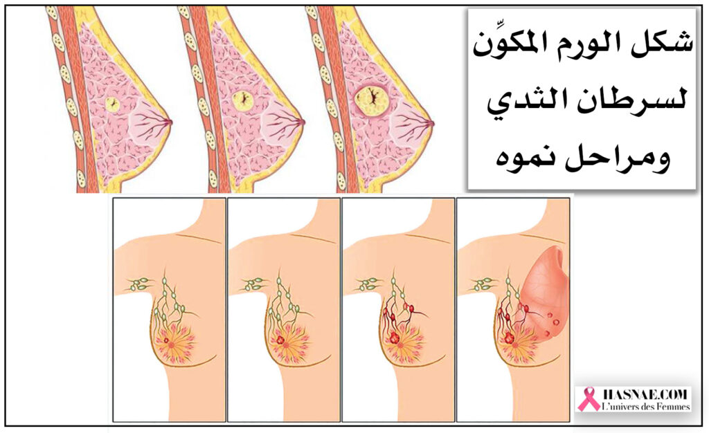شكل الورم المكون لسرطان الثدي ومراحل نموه